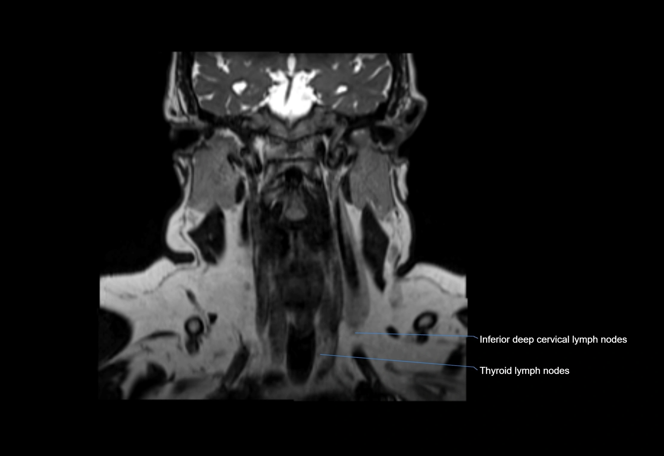 Neck coronal lymph node cross sectional MRI anatomy 3T MRI  image-img-00001-00035.webp
